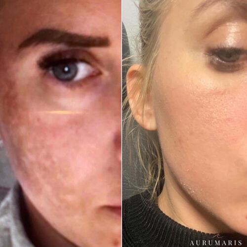 efekt-nano-needles Katarzyan S.