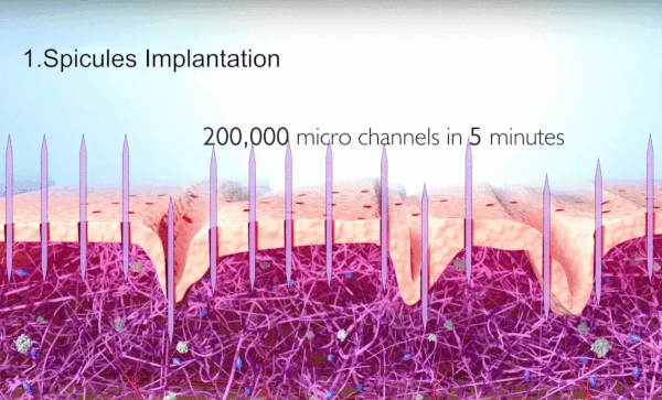 nano-needles-dzialanie-na-skore